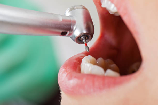 Best Emergency Broken Tooth Repair in Pinedale, WY